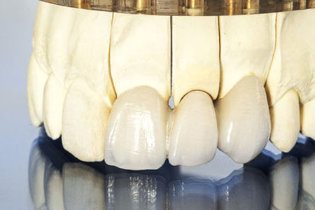 Porecelain Veneers Grande Prairie Higson Dental dental veneer treatment