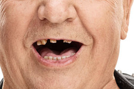 Full Mouth Reconstruction