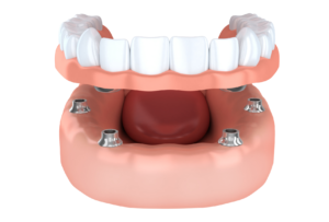 implant dentures higson dental dentist near you implant dentures cost