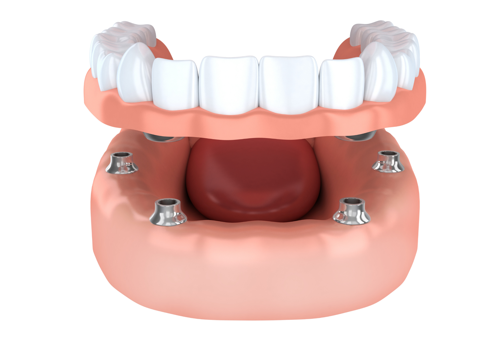 BEST Affordable Dentures in Grande Prairie, AB Affordable Dentures Near You