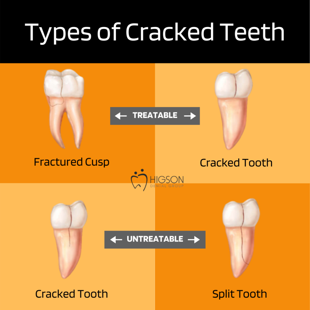 higson types of cracked teeth (1)