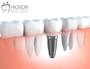 dental implant higson dental group