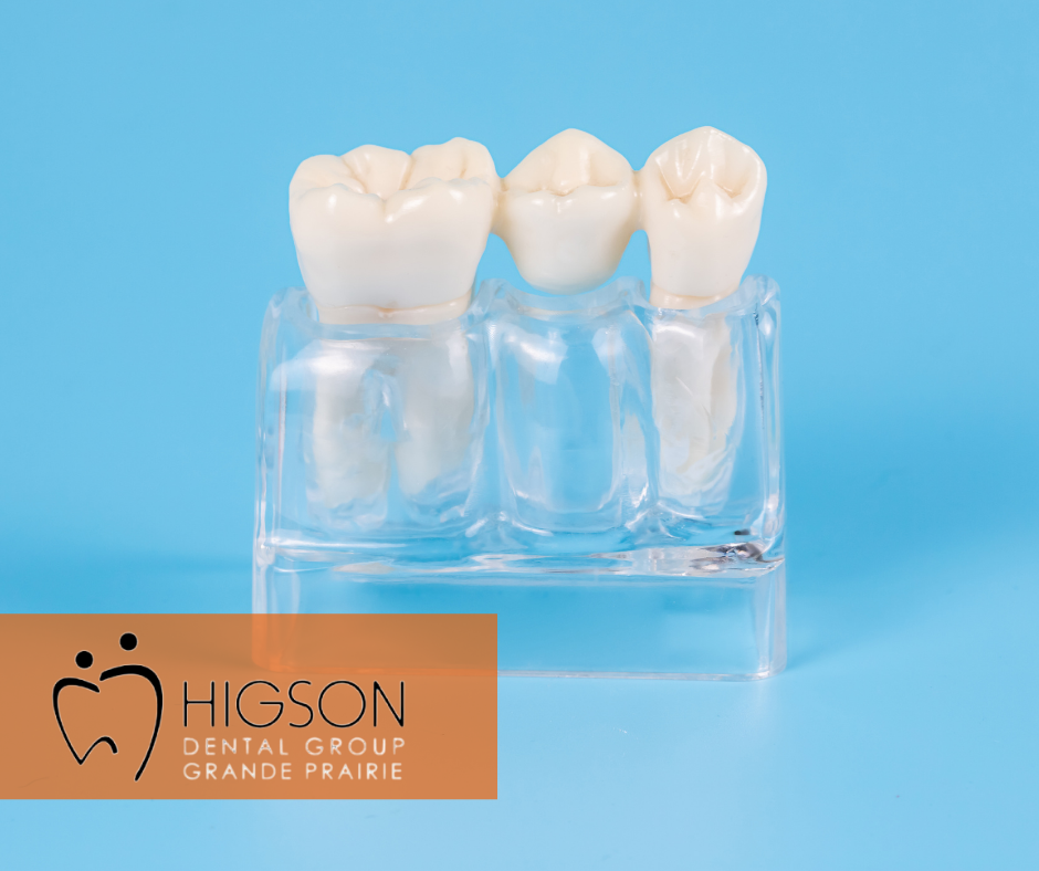 dental bridges near you grande prairie higson dental group