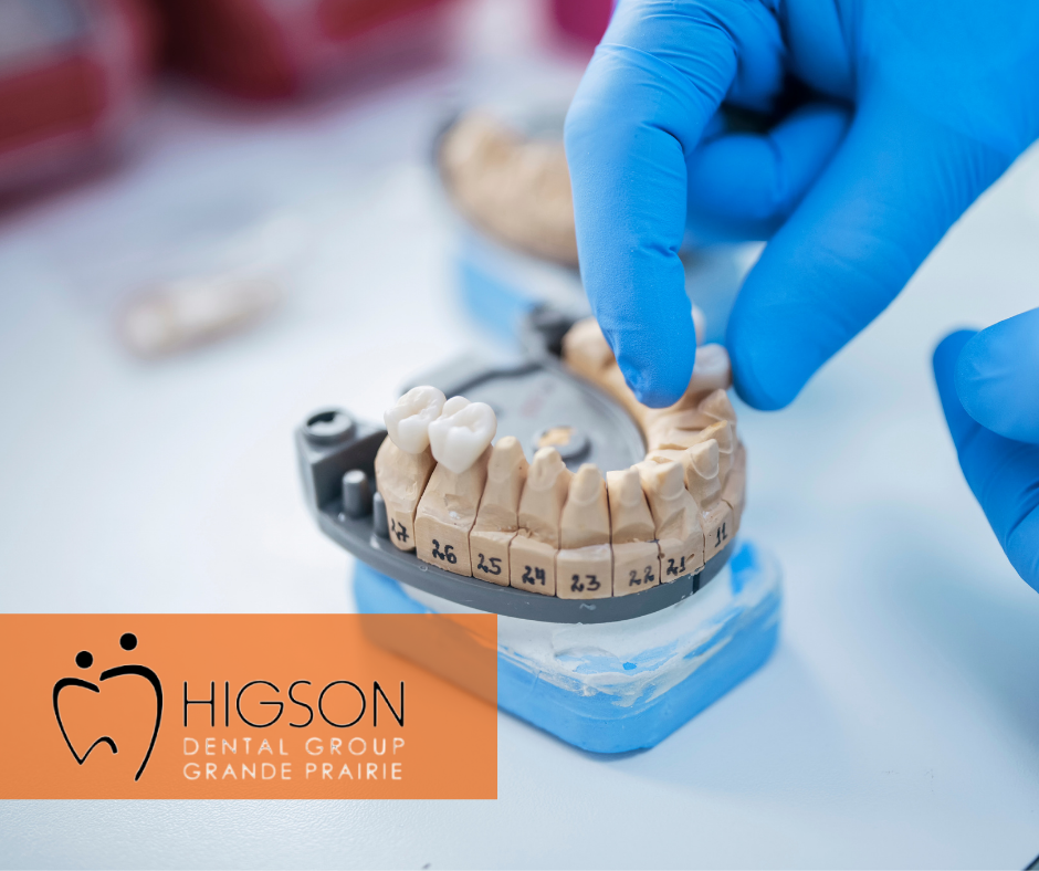 dental bridges near you higson dental group