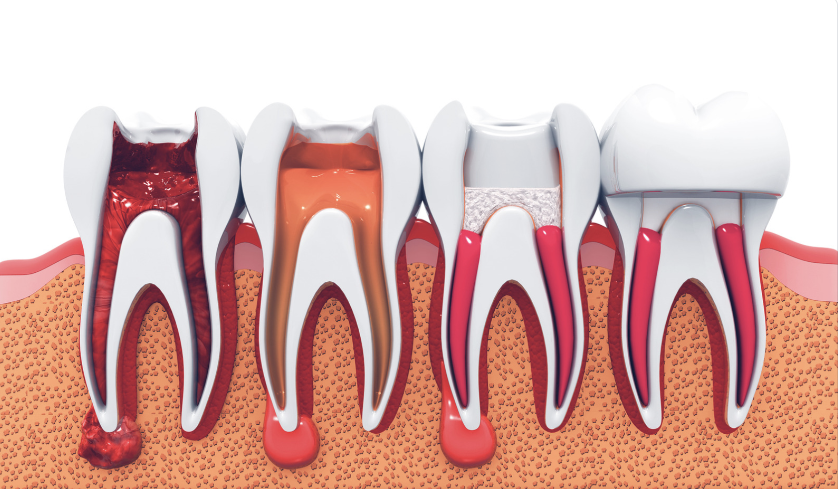 progression of a root canal infection - best root canal dentist in Grande Prairie AB
