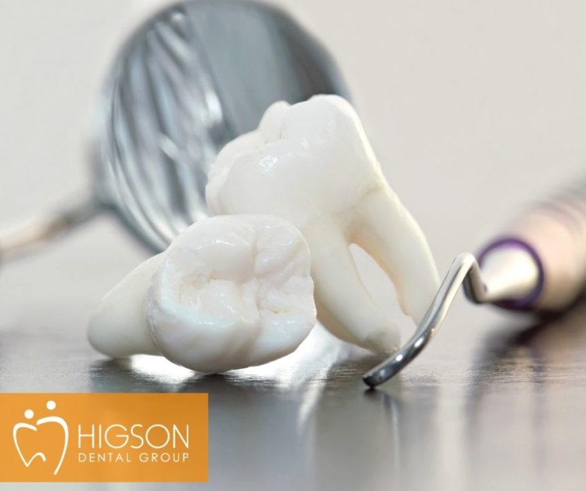 BEST Wisdom Teeth Removal Grande Prairie, AB Wisdom Tooth Removal Cost in Alberta Affordable