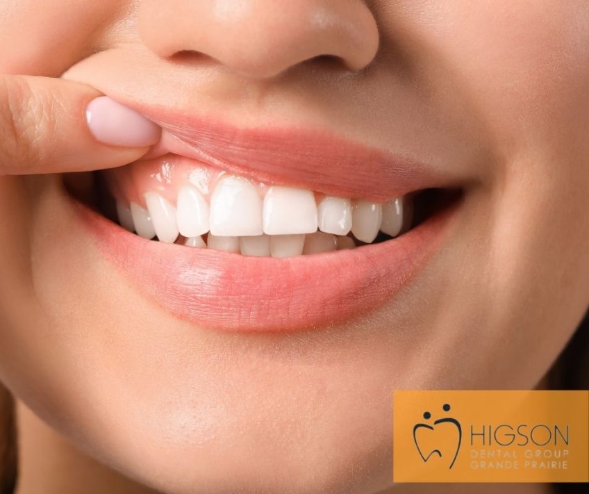 BEST Gum Graft in Grande Prairie, AB How Much Does a Gum Graft Cost