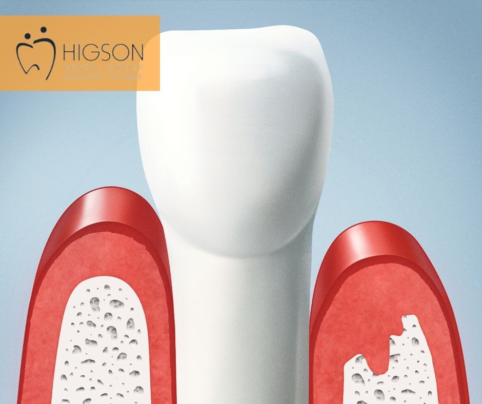 higson dental gum grafting (1)