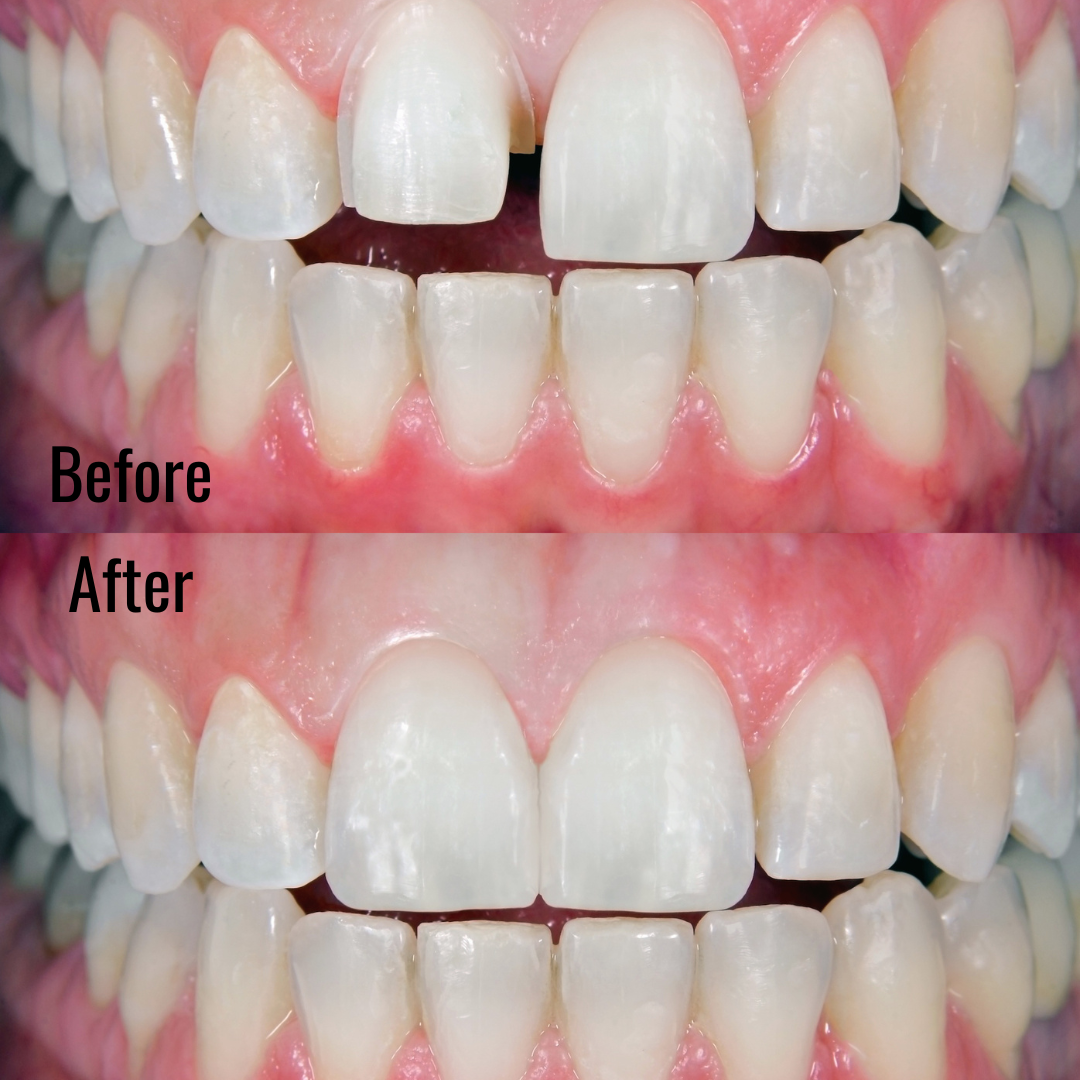 Higson Dental Teeth Bonding Before and After