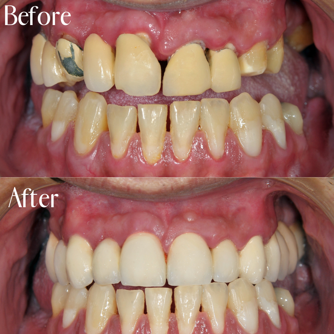 Higson Dental Group Full Mouth Reconstruction Before & After