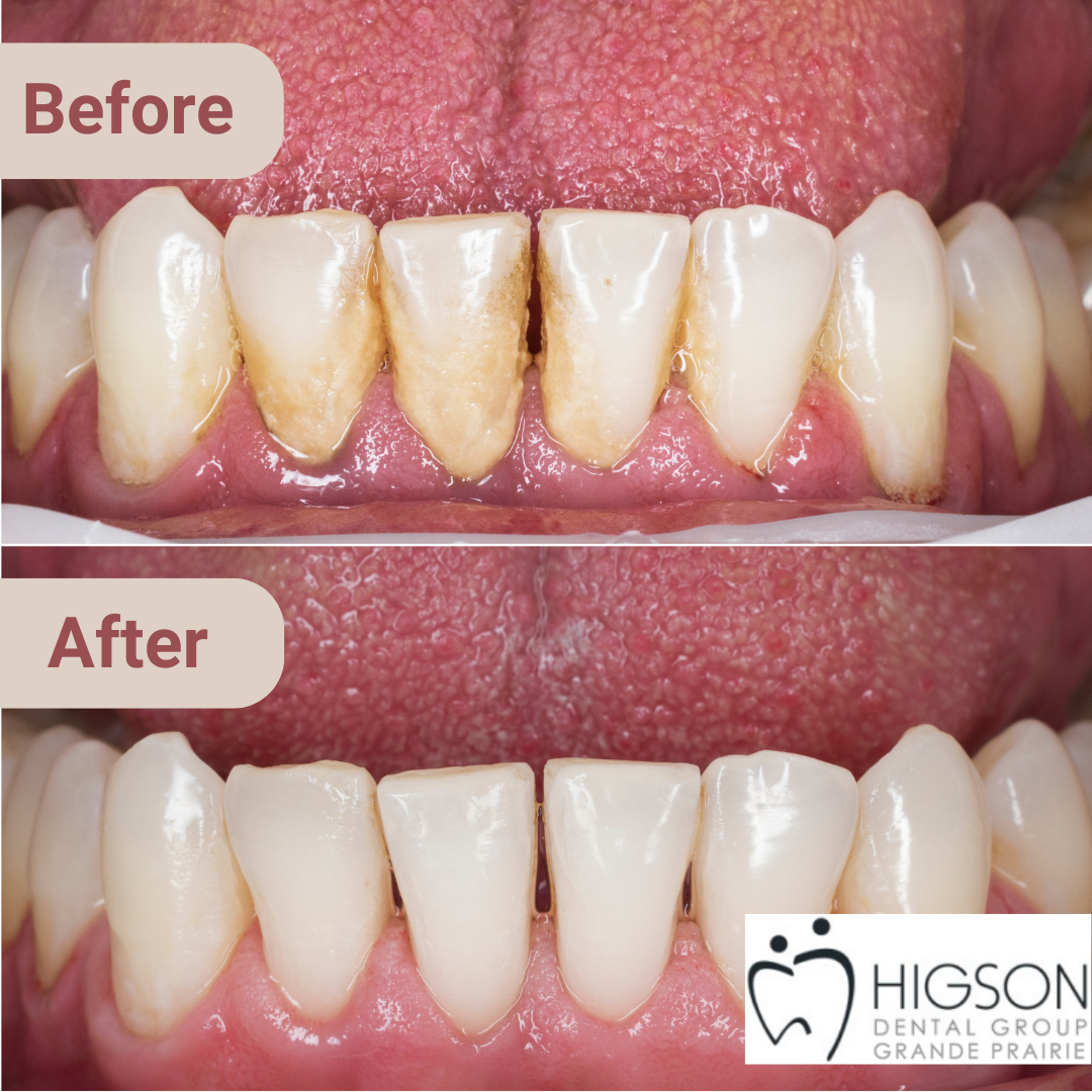 Tartar Removal Before and After Higson Dental Grande Prairie