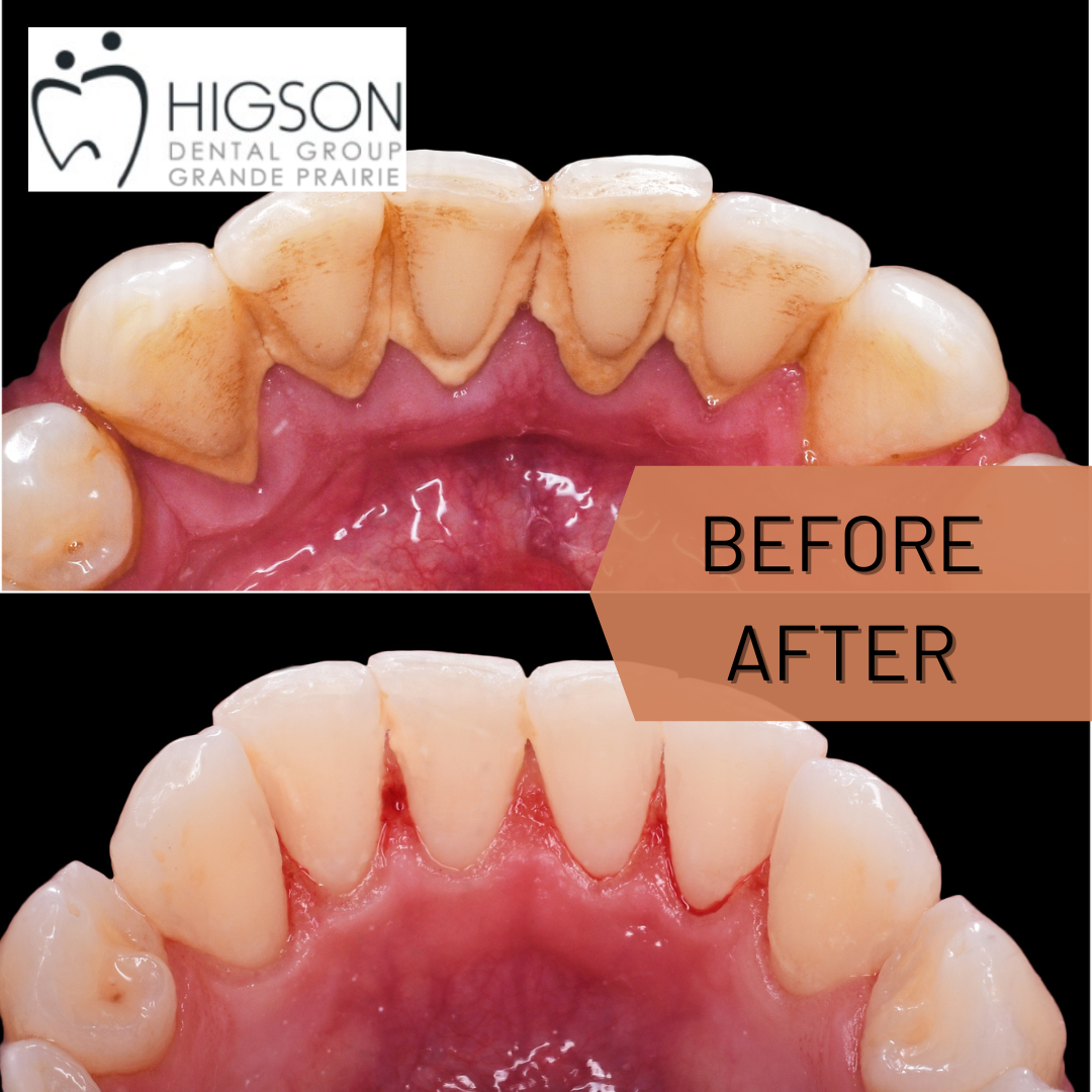 Tartar Removal Before and After Higson Dental