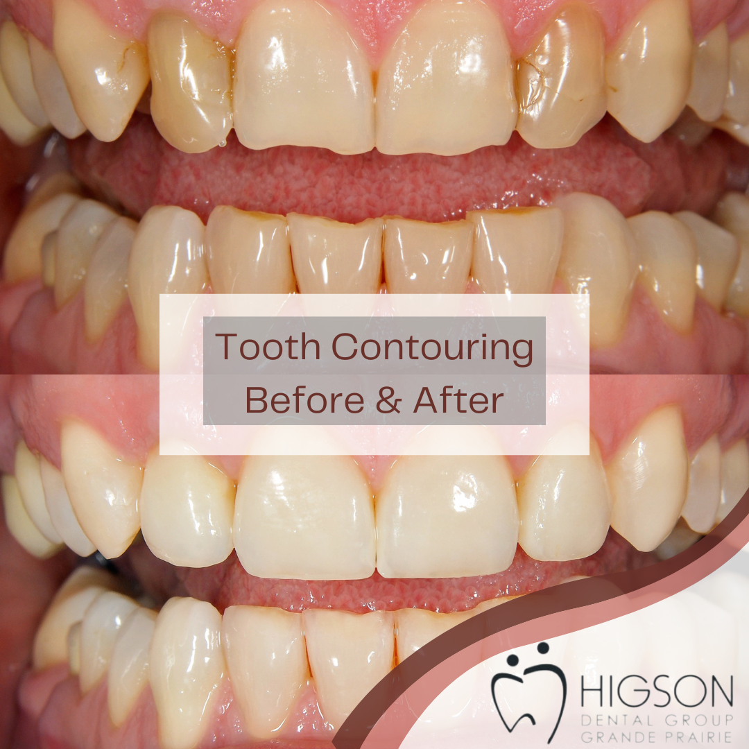 Tooth Contouring Before & After Higson Dental
