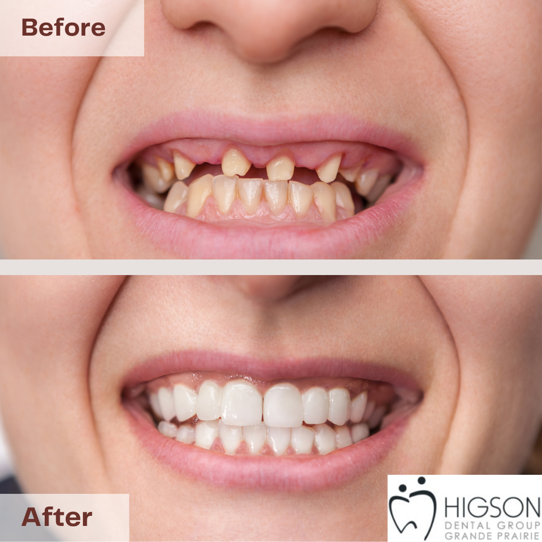 Dental Implants Before & After Higson Dental