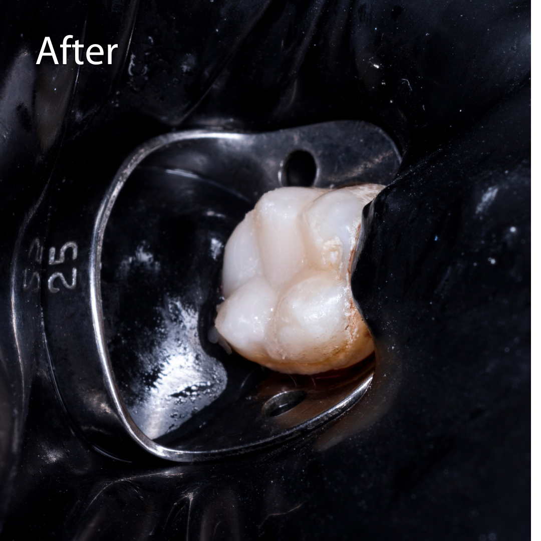 Higson Dental Group Root Canal After