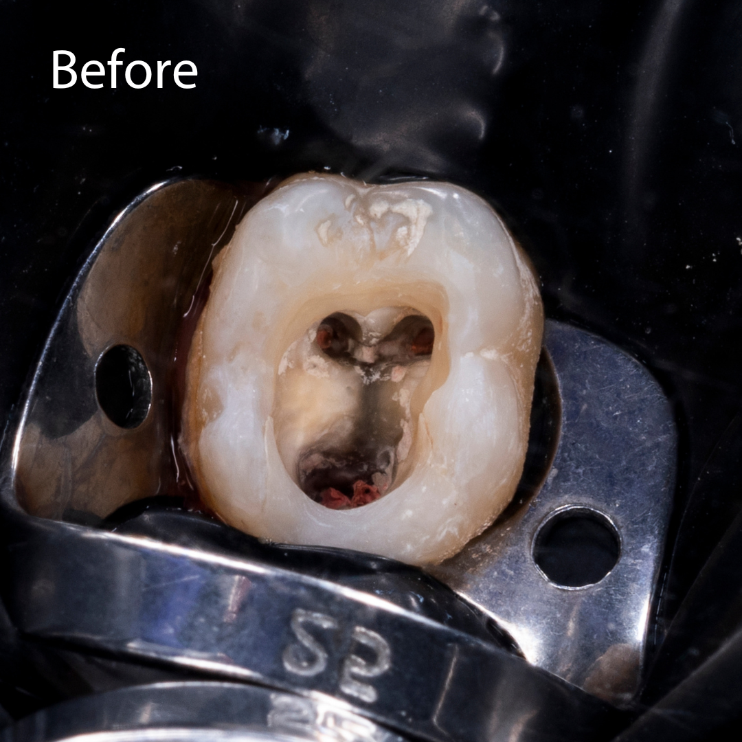 Higson Dental Group Root Canal Before