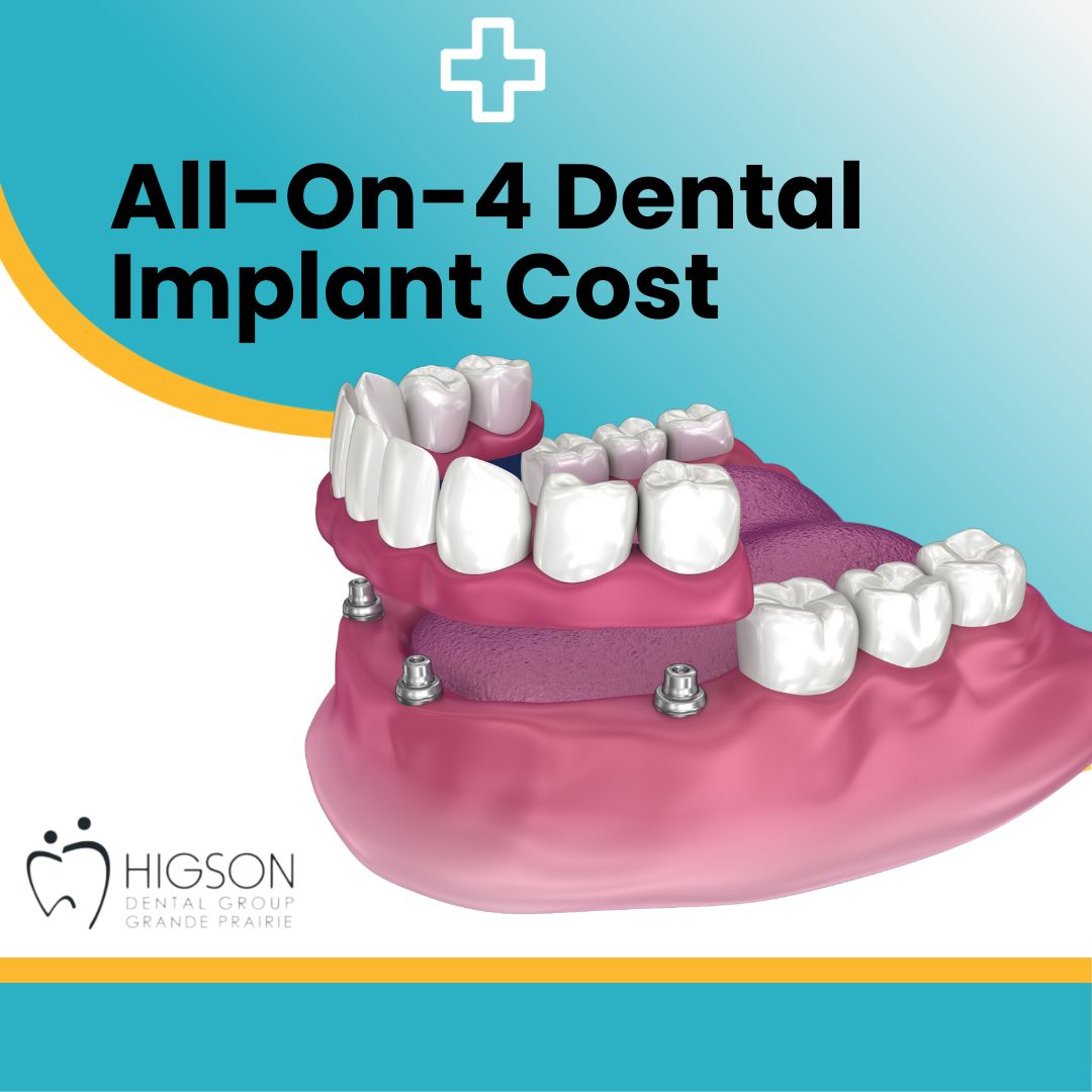 all on 4 dental implants cost